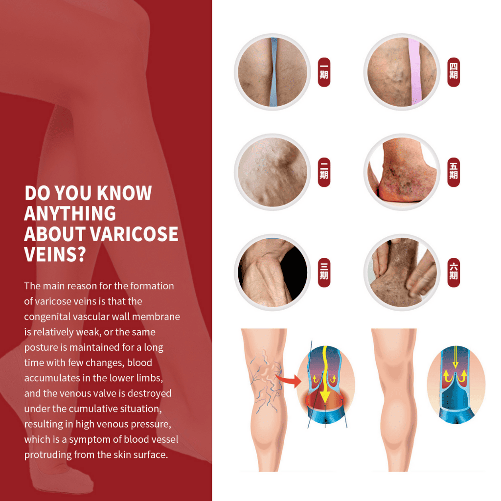 Varicose veins crema para varices
