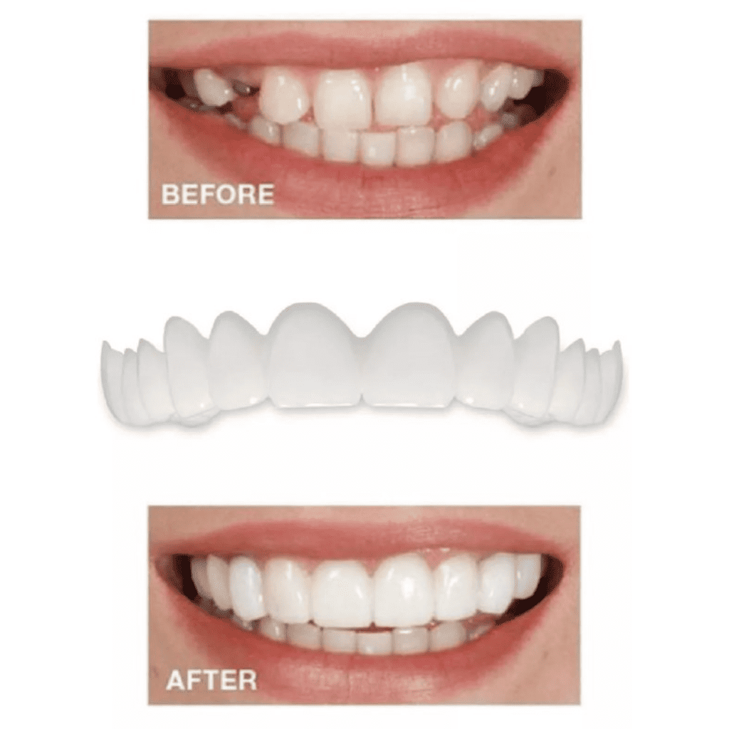 CARILLAS DE DIENTES POSTIZOS DE SONRISA